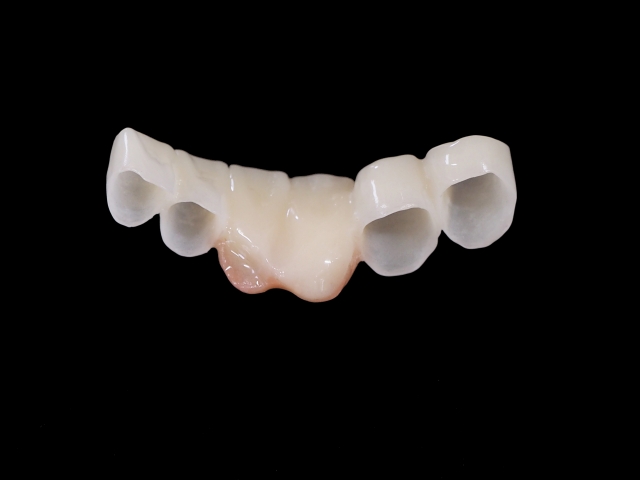 『インプラント治療における「仮歯」とは』イメージ